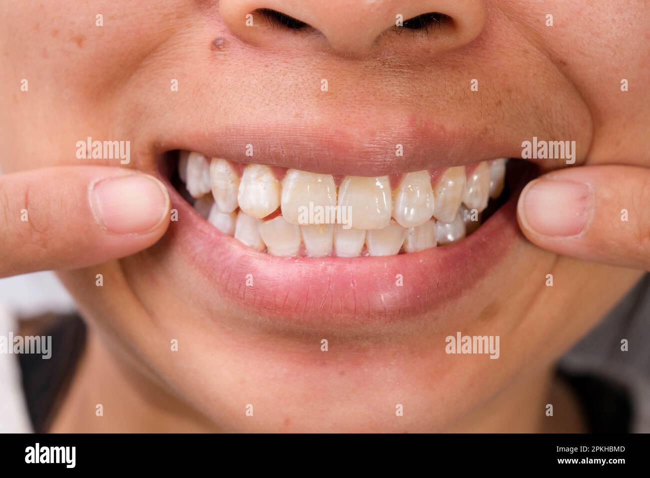 Close-up of a smiling woman's teeth revealing white spots and plaque on the tooth surface. Oral care and Dental concept. Stock Photo