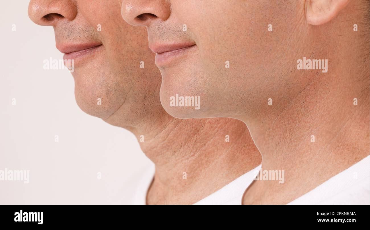 Surgery or mewing exercises. Result of a jawline reshape. Stock