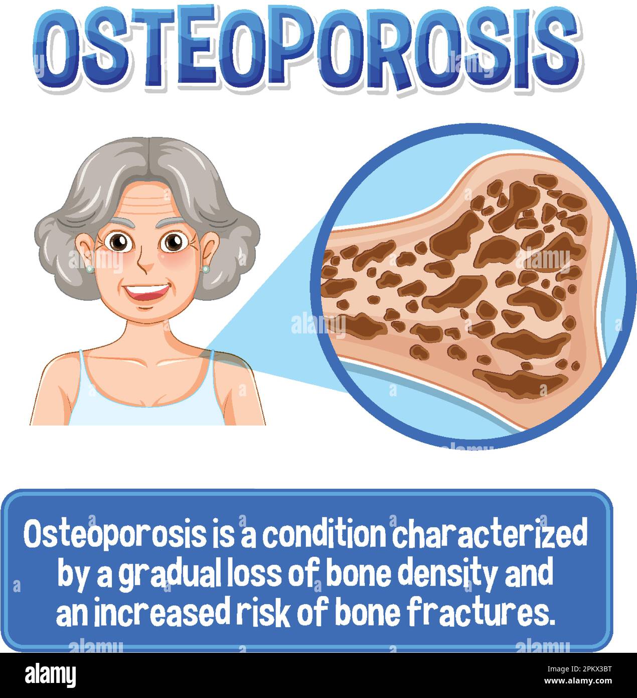 Informative poster of Osteoporosis human bone illustration Stock Vector