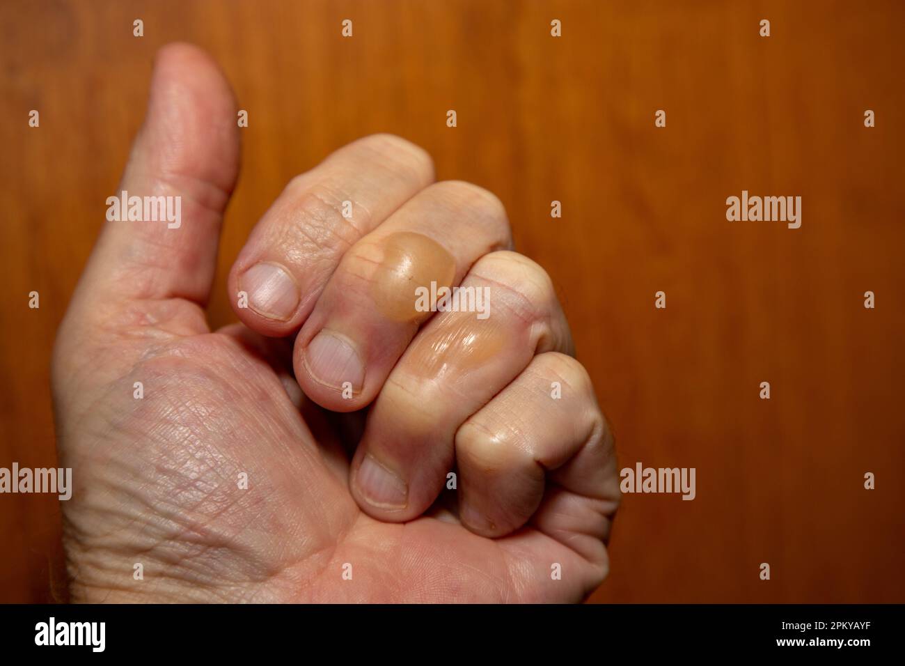 Typical skin blisters from seconddegree boiling oil burns Stock Photo Alamy