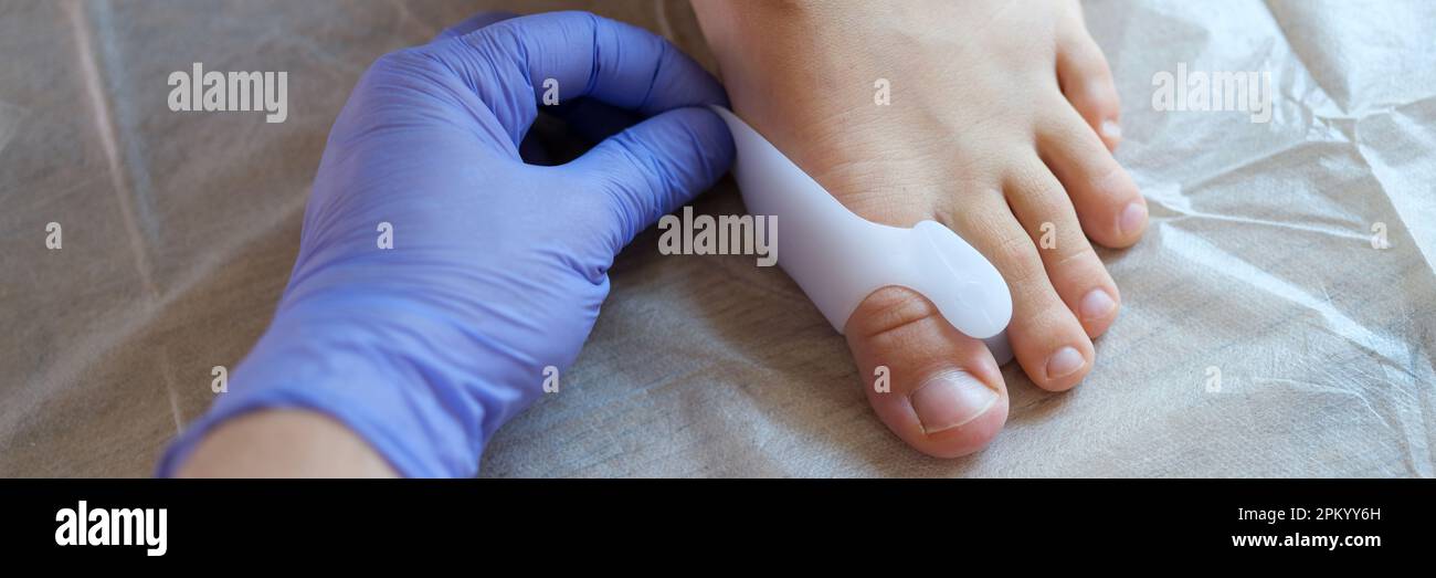 Doctor orthopedist applying brace for hallux valgus Stock Photo