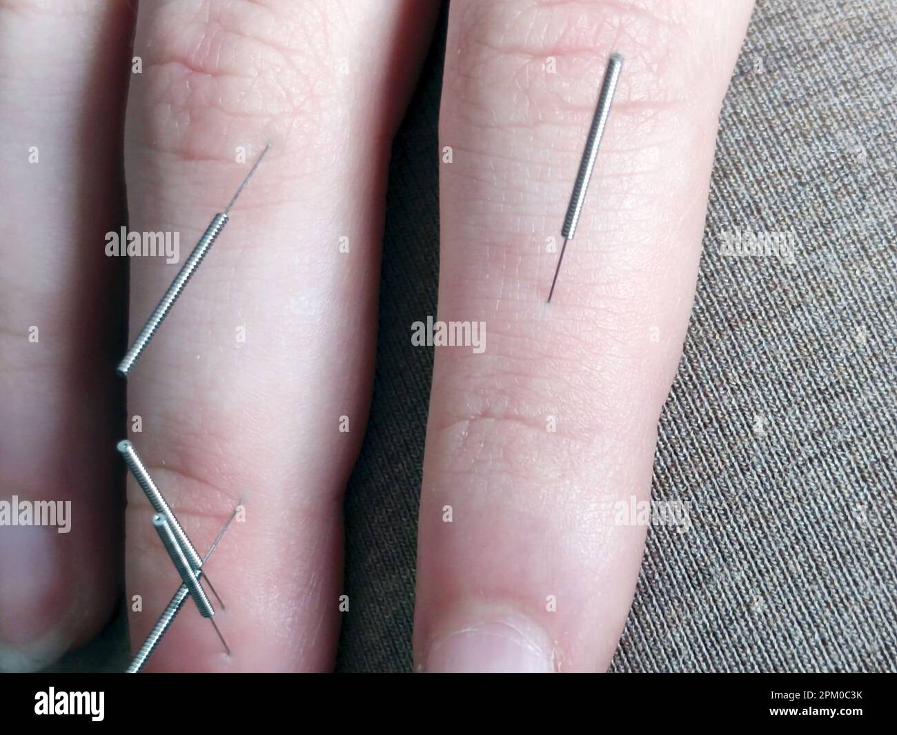 Su Jok therapy, Su Jok needles on female fingers close-up Stock Photo