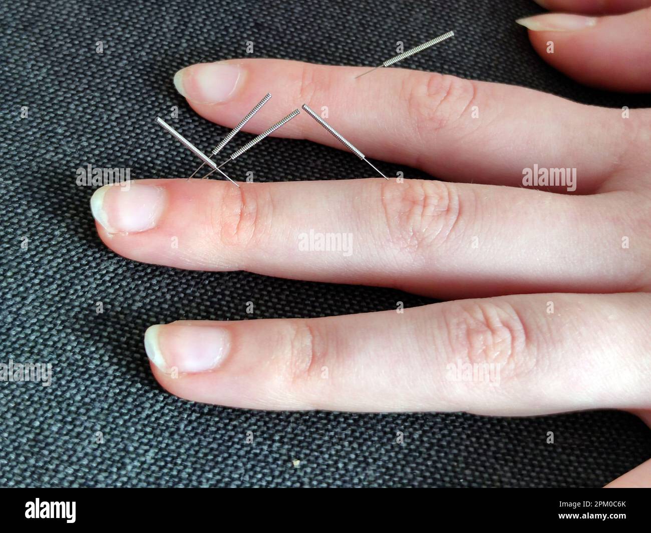 Su Jok therapy, Su Jok needles stuck in the fingers at special points. Stock Photo