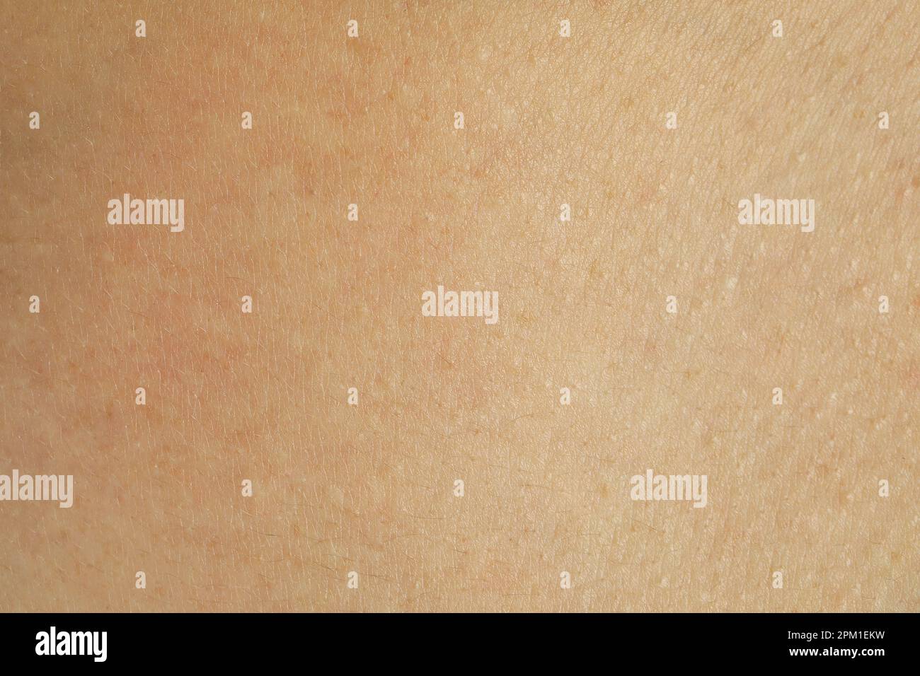 Texture of human skin with birthmarks, closeup view Stock Photo - Alamy