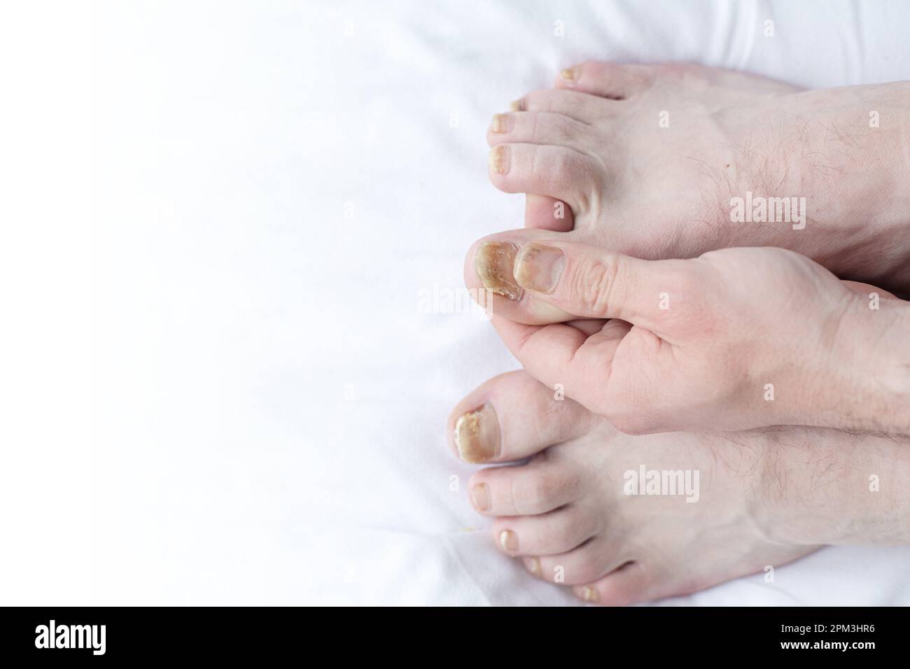Male cut nails with nail fungus. Fungal infection on nails legs, finger with onychomycosis. Care and treatment. Closeup of a foot with damaged nails b Stock Photo