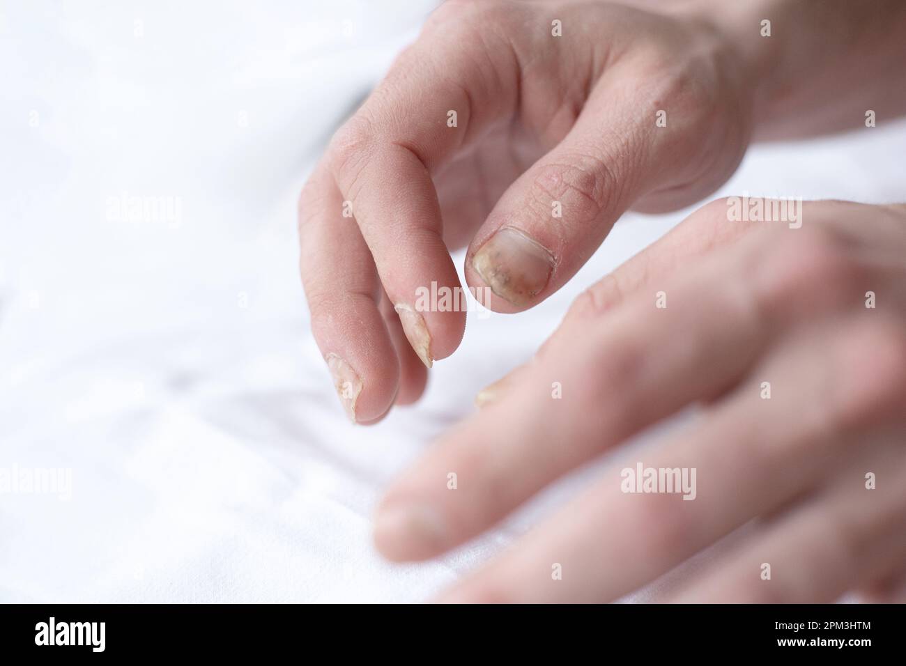Male cut nails with nail fungus. Fungal infection on hands legs, finger with onychomycosis. Care