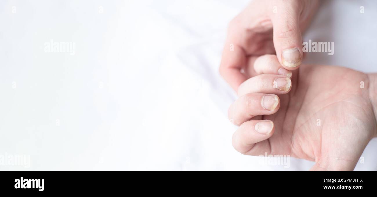 Male cut nails with nail fungus. Fungal infection on hands legs, finger with onychomycosis. Care