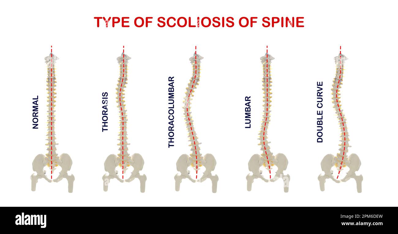 Medical poster demonstrating types of scoliosis on white background
