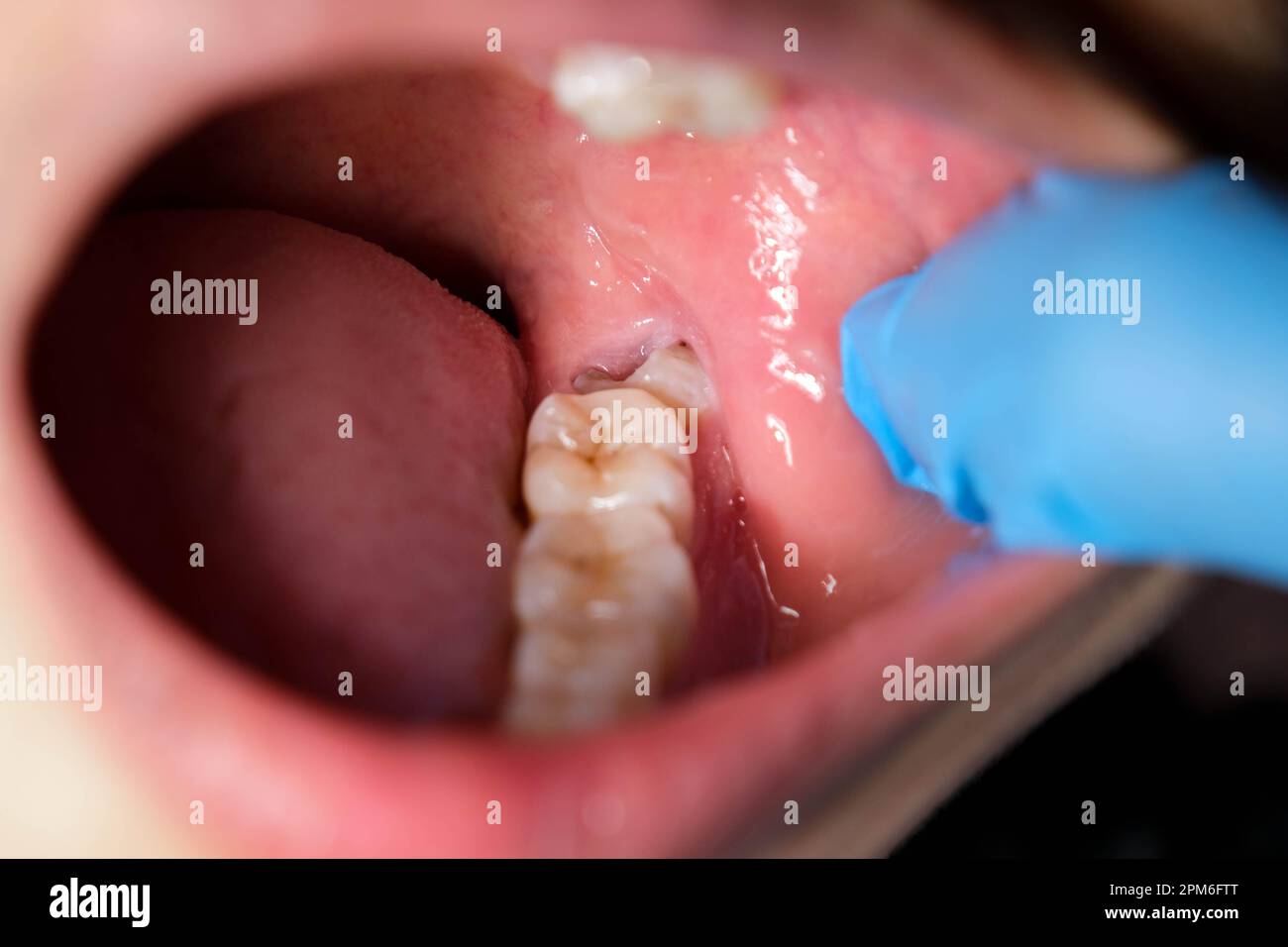 Wisdom teeth affect and cause gum recession. Stock Photo