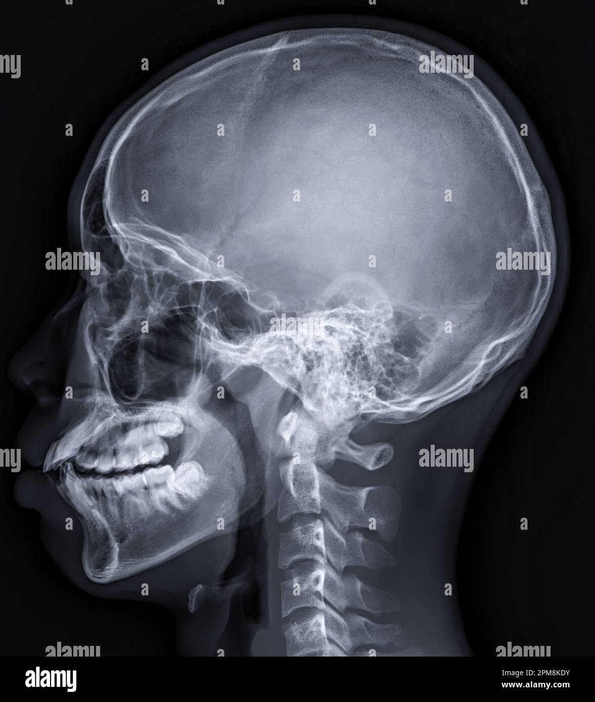 xray image of Human Skull lateral view for diagnosis skull fracture
