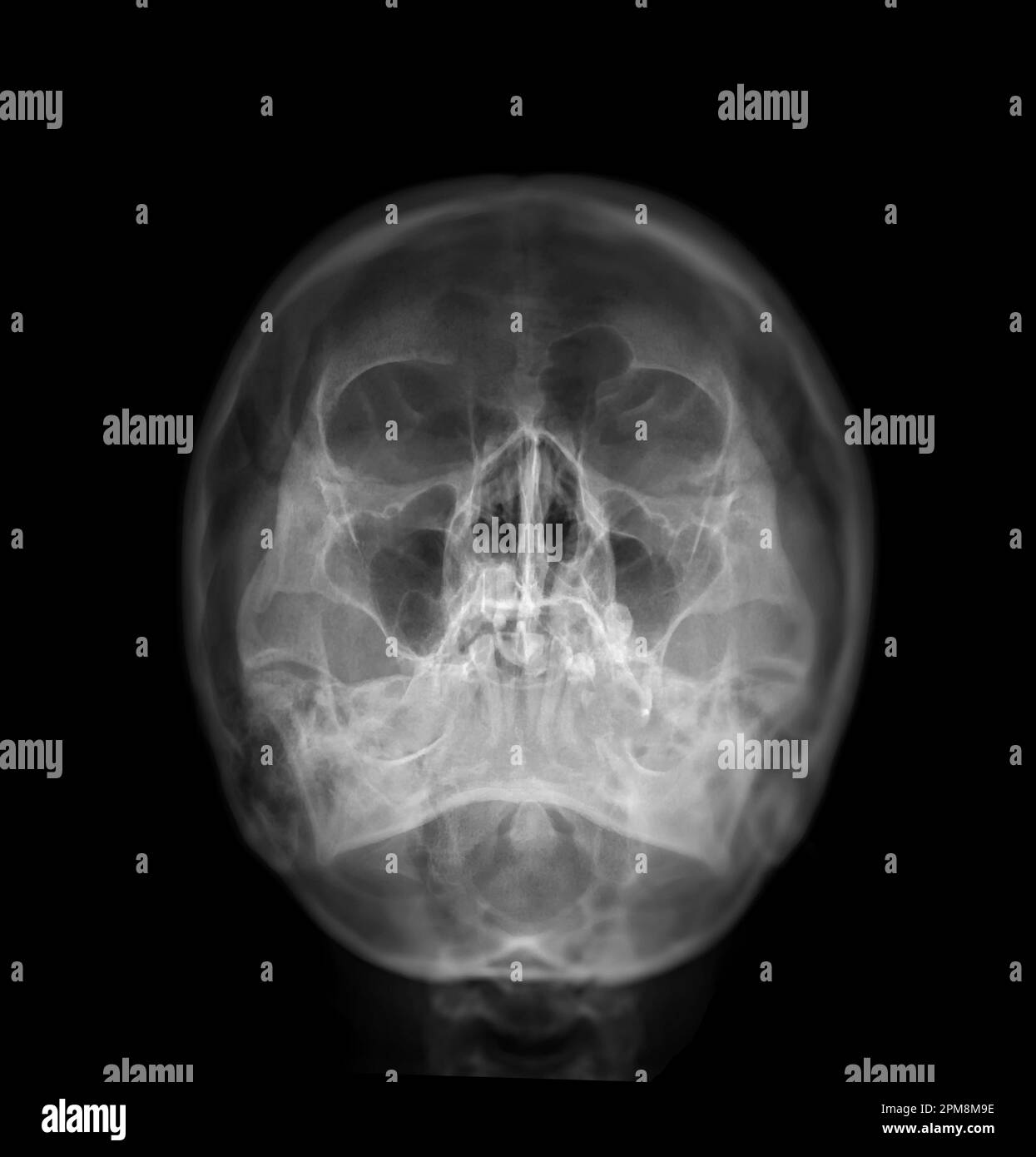 Xray image of Human Skull Water's view for diagnosis skull fracture