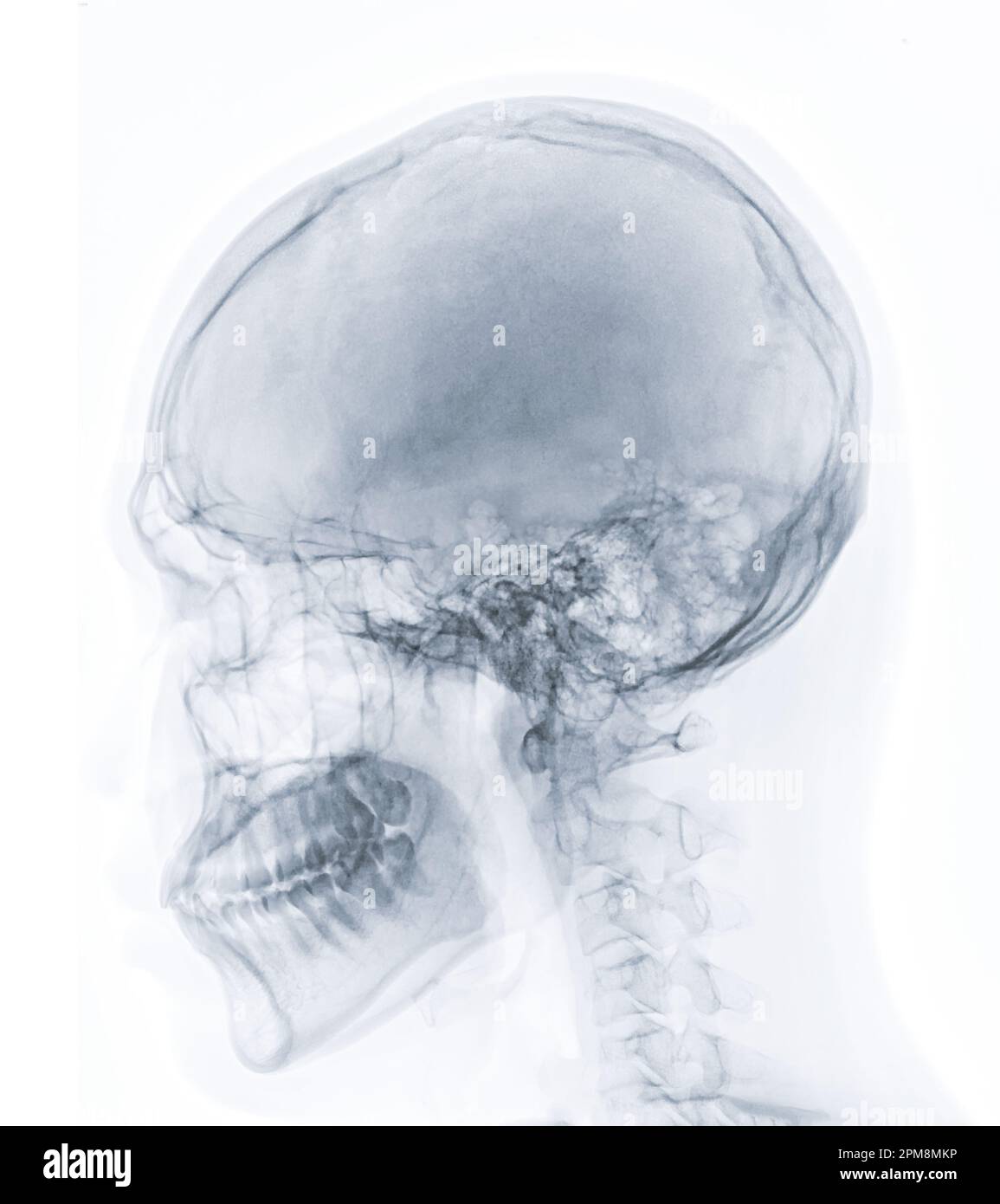 x-ray image of Human Skull lateral view for diagnosis skull fracture ...