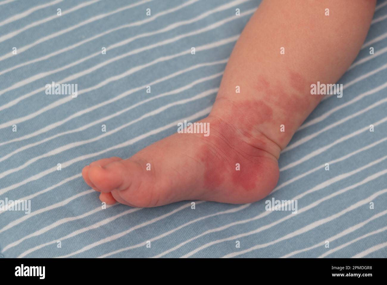 Hemangioma red birthmark on leg of newborn baby Stock Photo