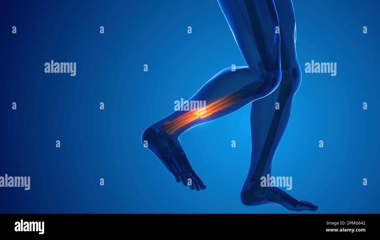 Broken leg bone pain medical concept Stock Photo