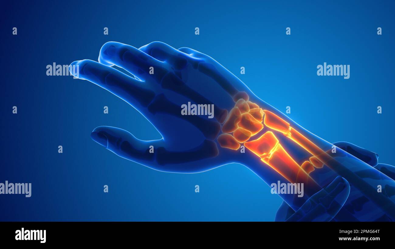 Broken Wrist bone pain medical concept Stock Photo Alamy