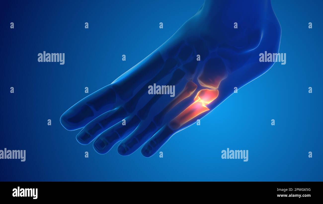 Fracture foot bone pain medical concept Stock Photo