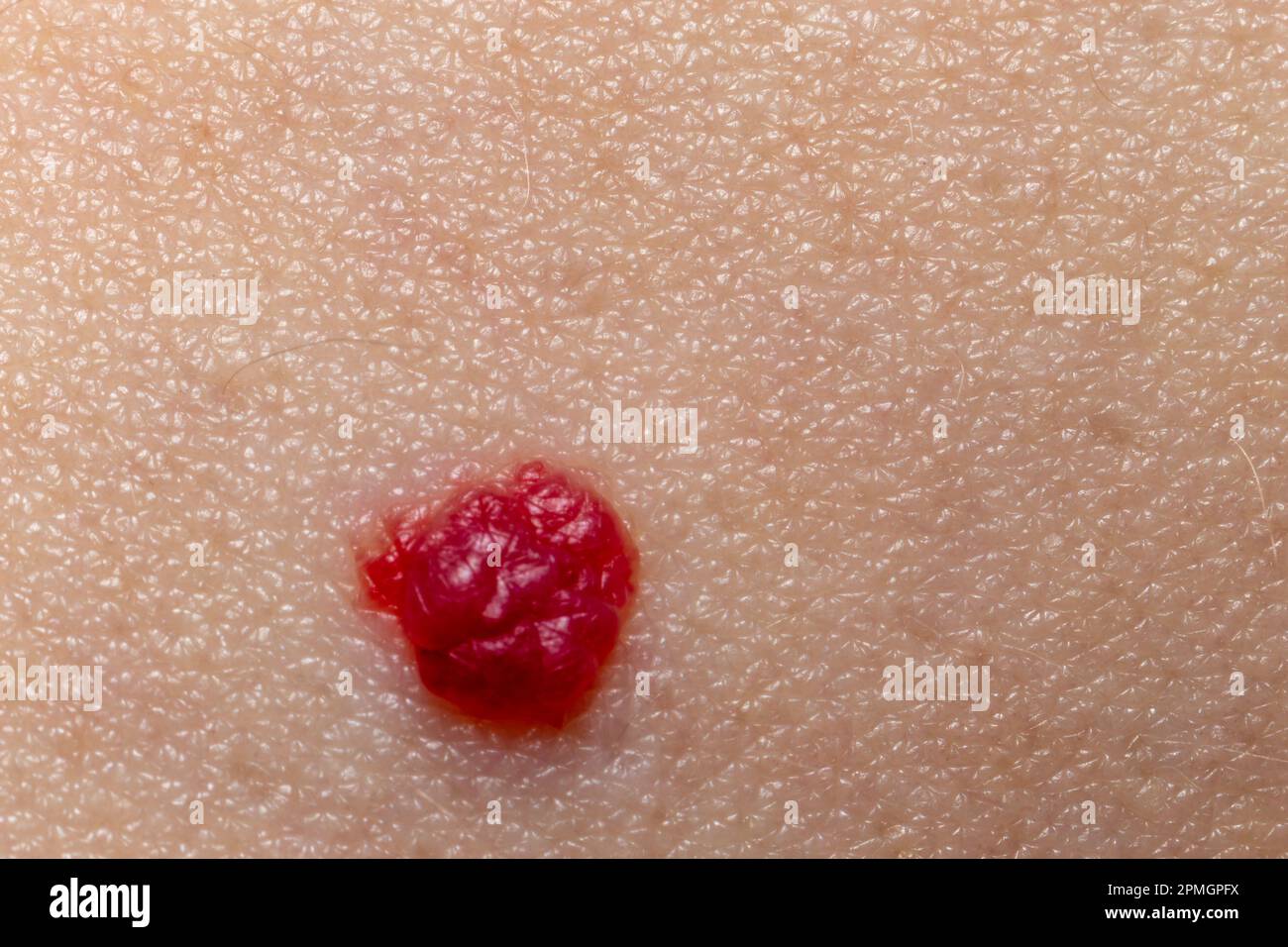 Red mole on skin extreme closeup view, macro Stock Photo Alamy