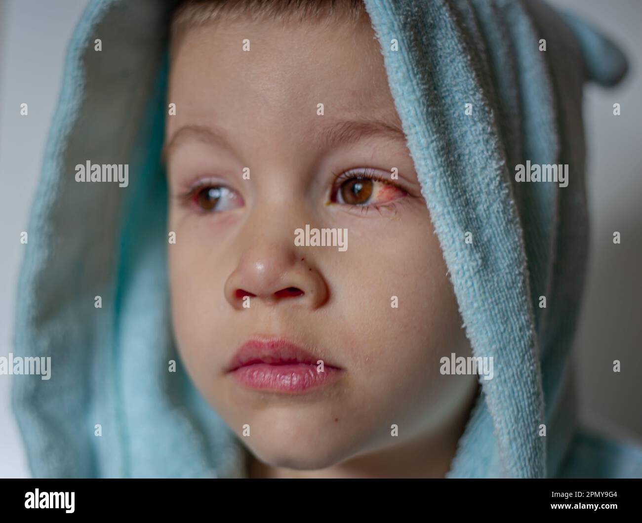 A young child with spoiled eyes suffers from conjunctivitis.Close up of