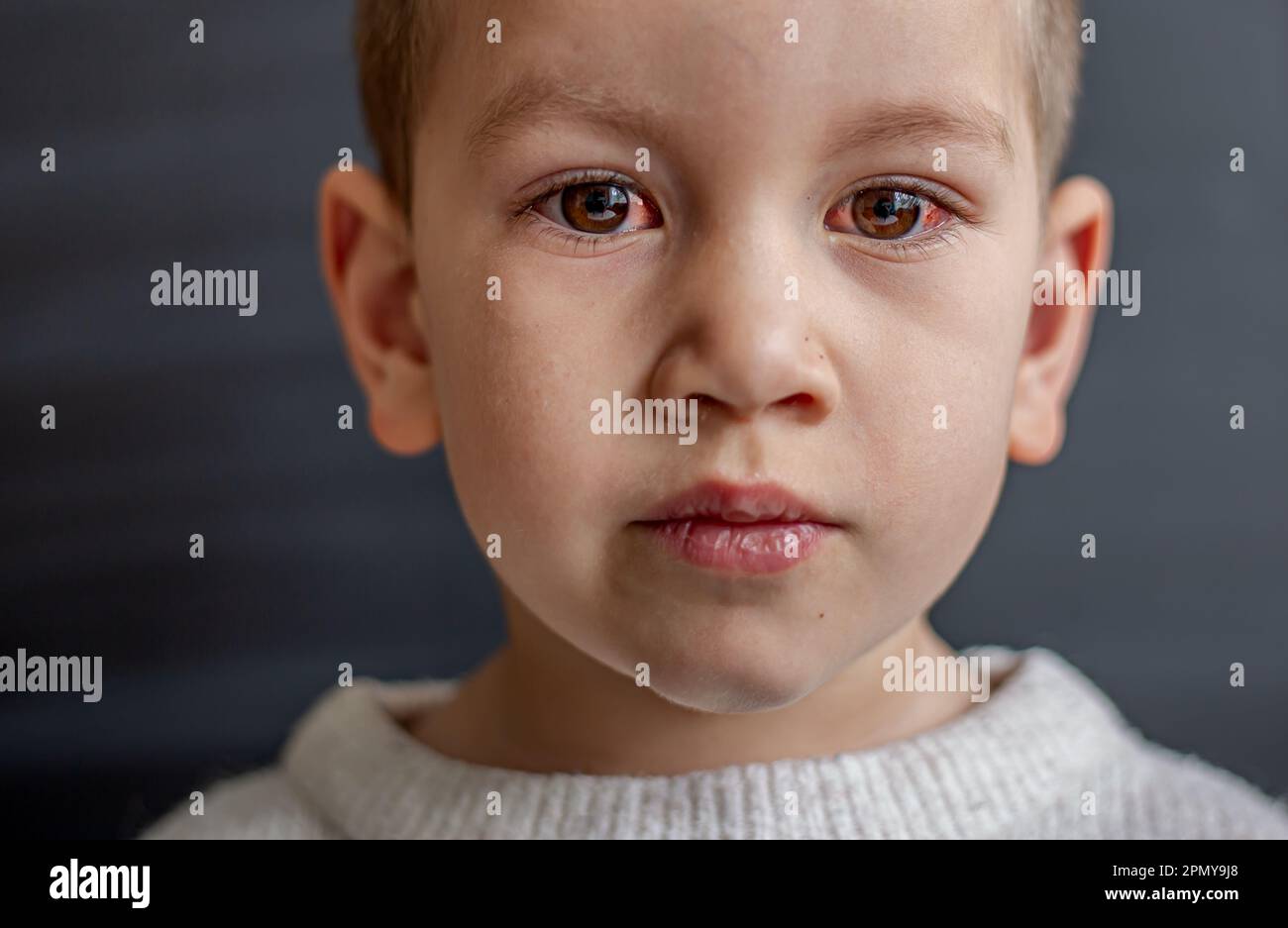 A young child with spoiled eyes suffers from conjunctivitis.Close up of