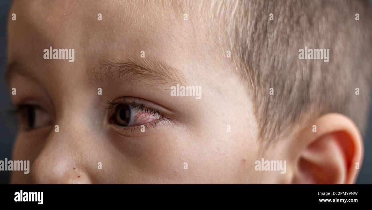 A young child with spoiled eyes suffers from conjunctivitis.Close up of