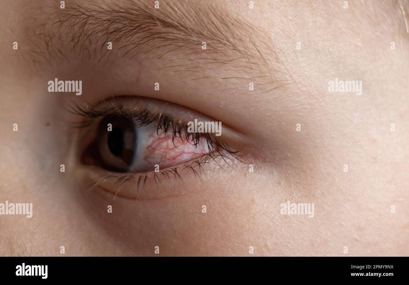 A young child with spoiled eyes suffers from conjunctivitis.Close up of