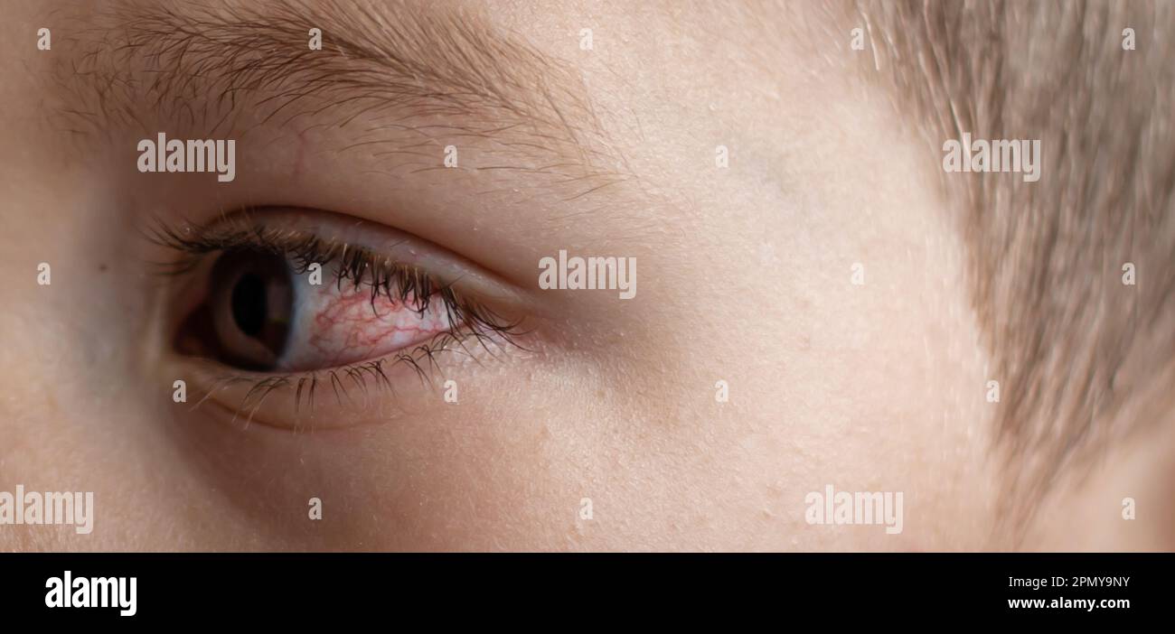 A young child with spoiled eyes suffers from conjunctivitis.Close up of