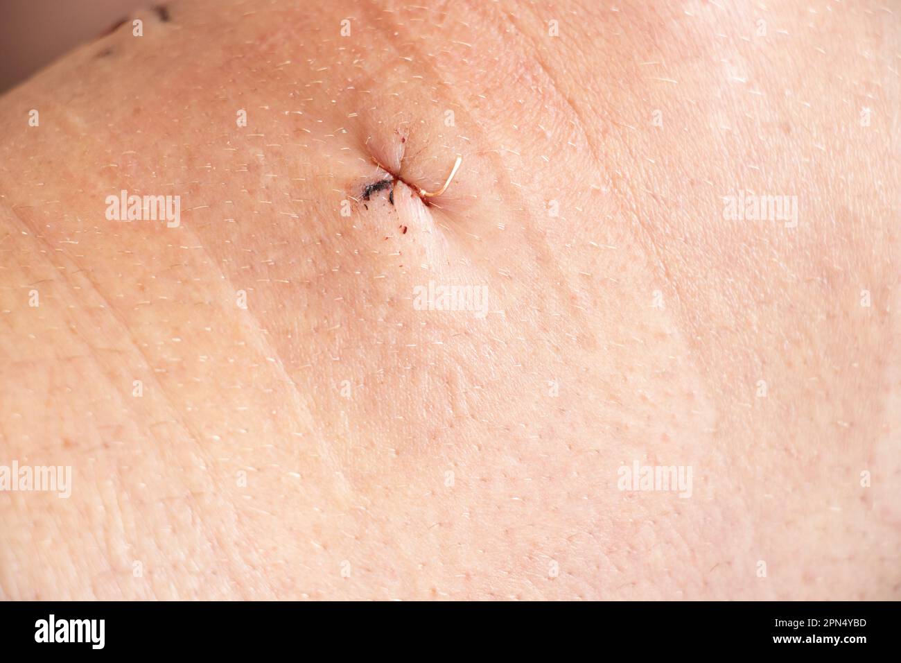 Postoperative sutures on the knee and lower leg after meniscus replacement in a man, stitched incisions Stock Photo