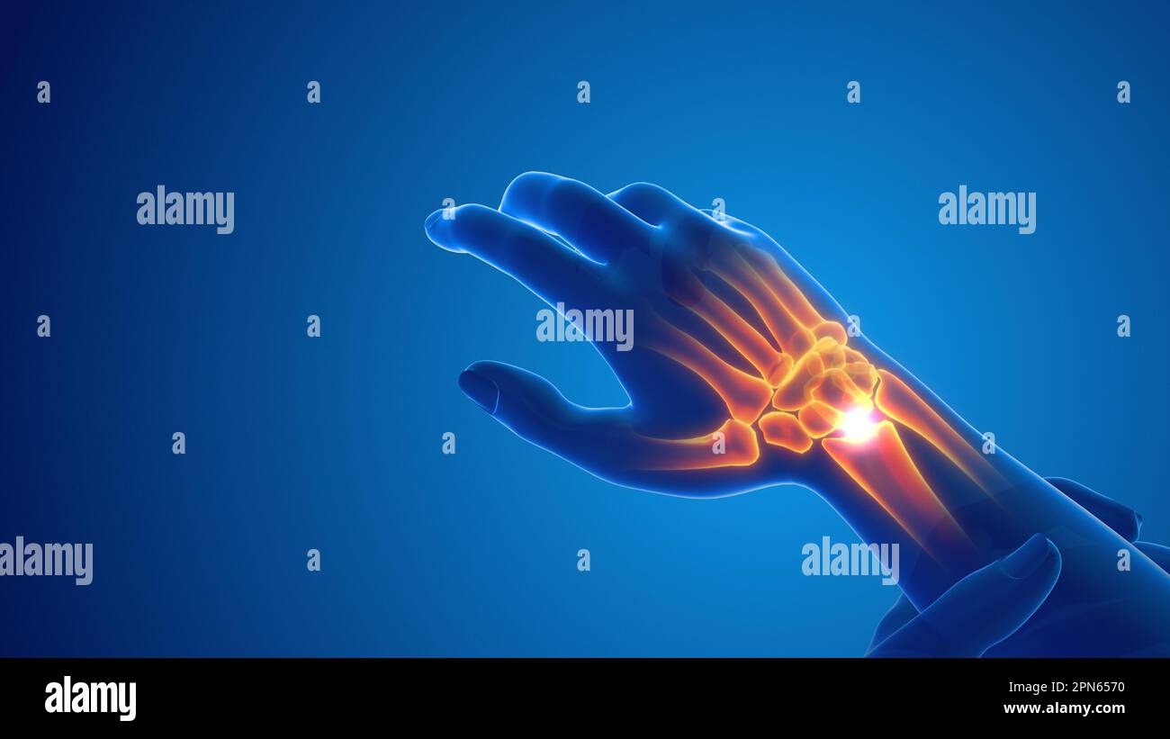 Pain in the wrist joint Stock Photo Alamy