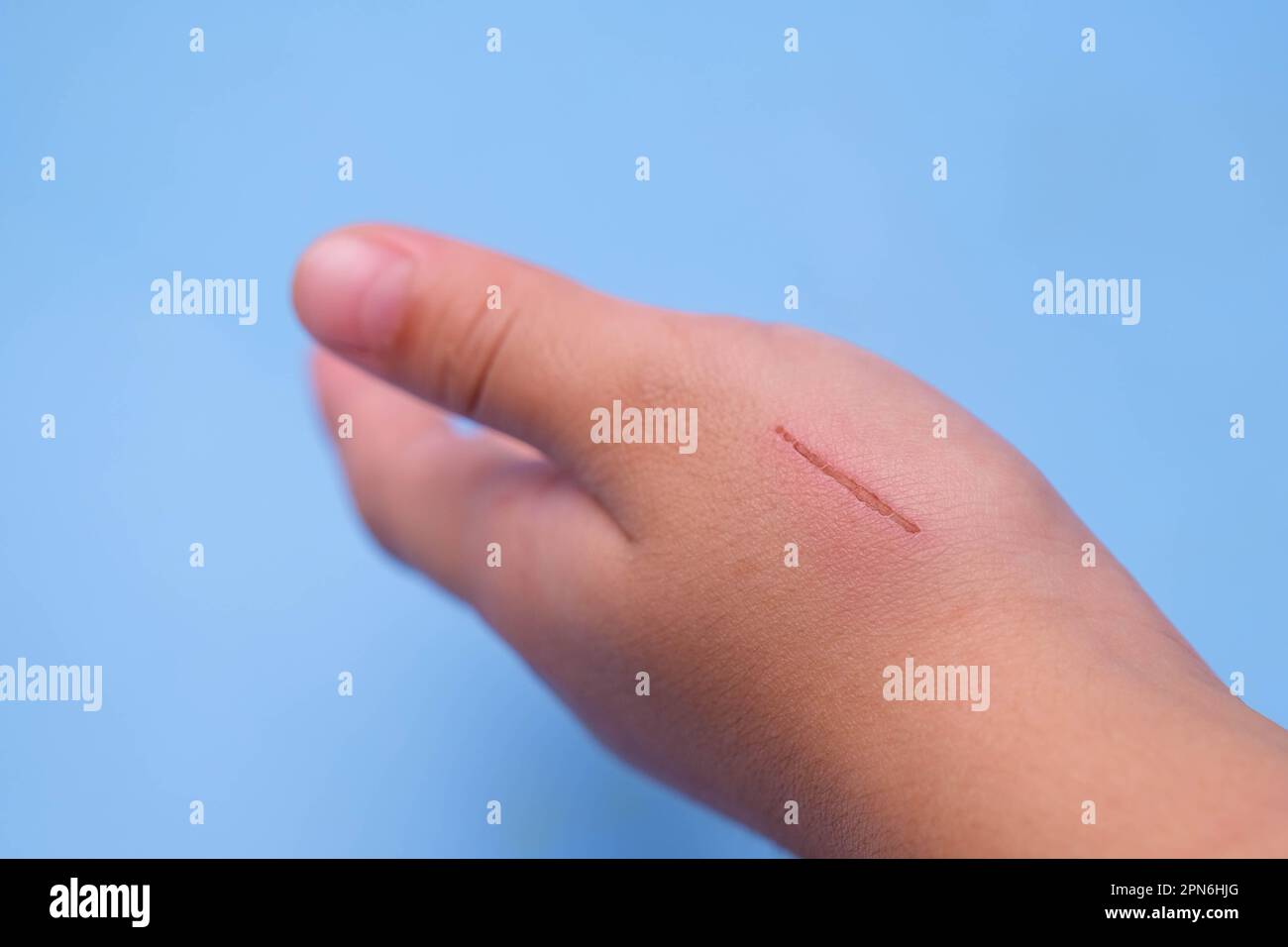 Close-up of a scratch on the skin of a child's hand. Wounds or ...