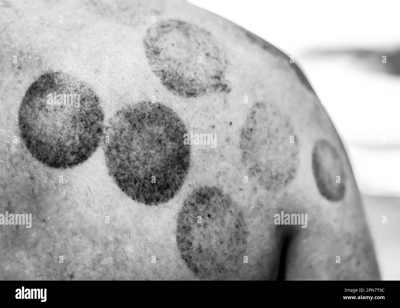 Circular bruises on a back and shoulder after cupping therapy Stock