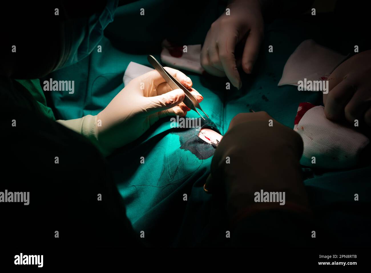 Close-up of a surgeon's hands closing the skin after removing a dermatological lesion. Suture with needle holder, silk suture, forceps and sterile glo Stock Photo
