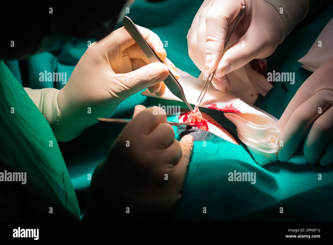 Close-up of the hands of a surgeon operating on a dermatological lesion, a fibroid. Resection with scalpel, forceps and sterile gloves on a green ster Stock Photo