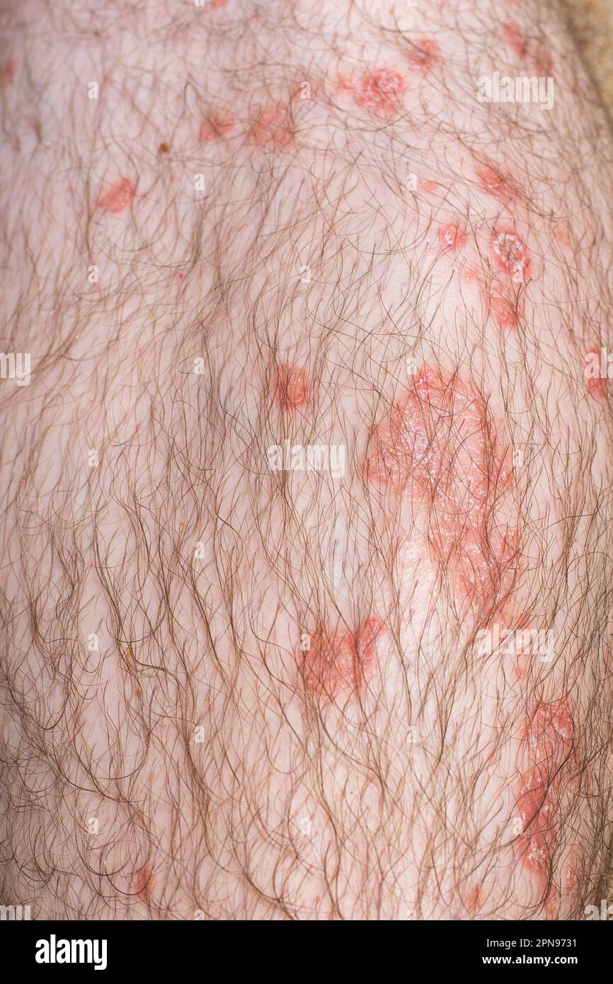 red scaly ulcers on the skin of a male leg. Immune disease psoriasis in adulthood. Stock Photo