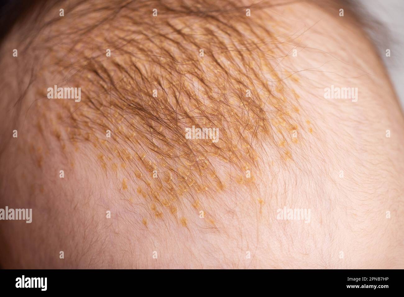 the process of formation of seborrheic dermatitis in an infant on the