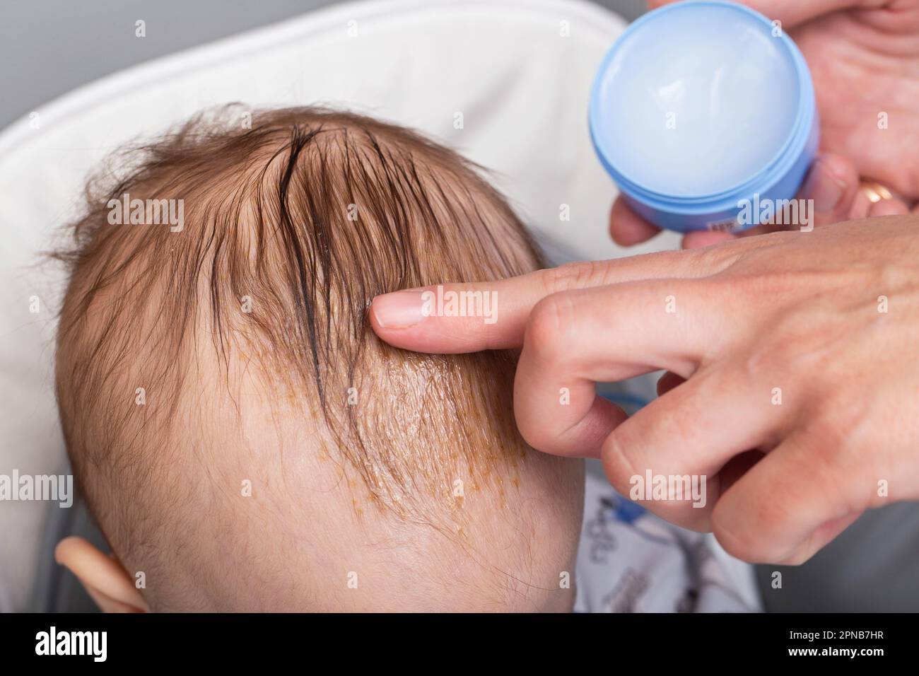 Applying a special cream and oil to the child's scalp to remove gneiss