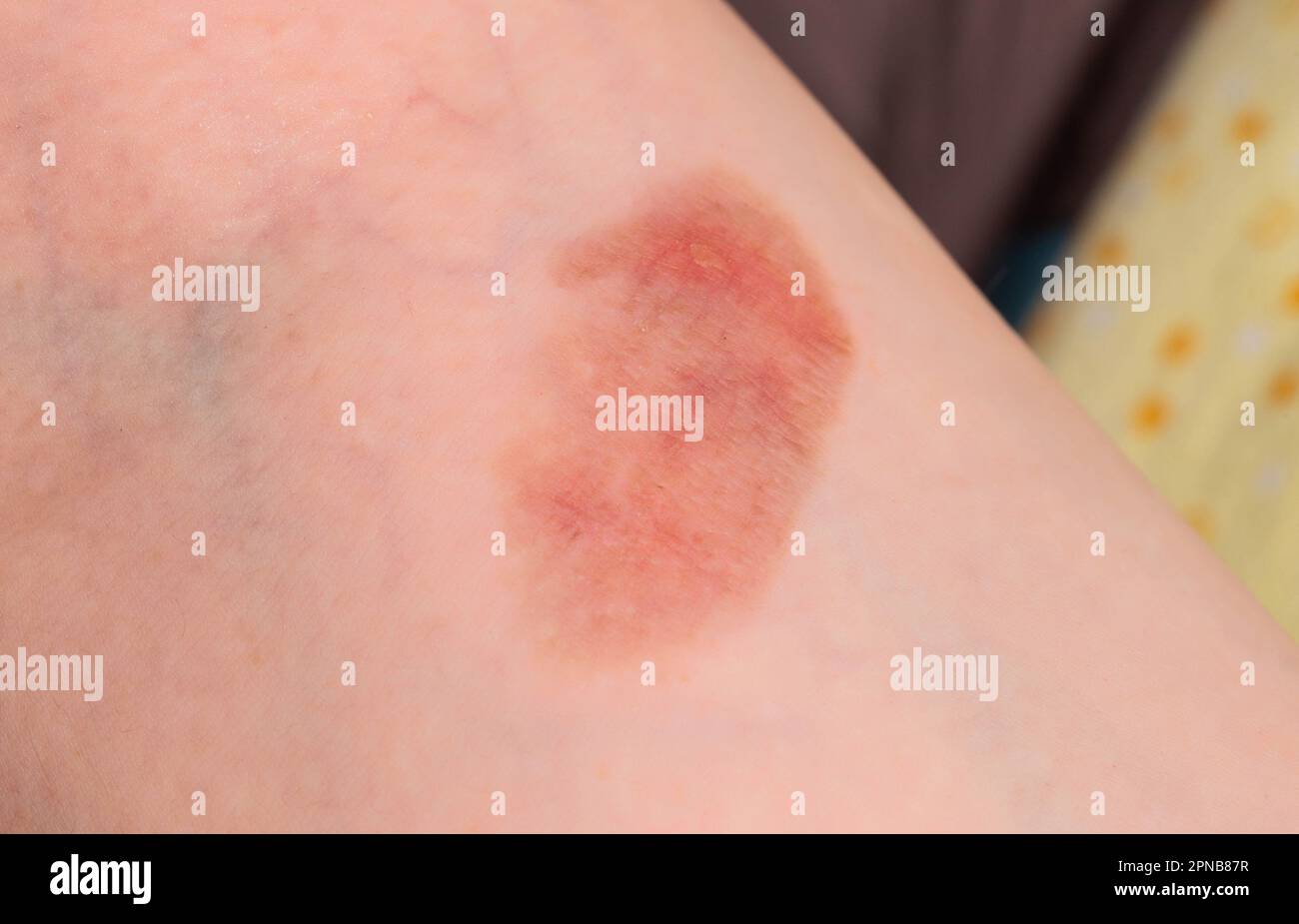 Red spot on the skin, skin damage from a burn on the arm Stock Photo