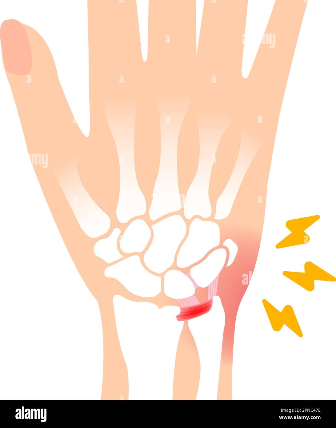 About TFCC injury. Vector illustration Stock Vector