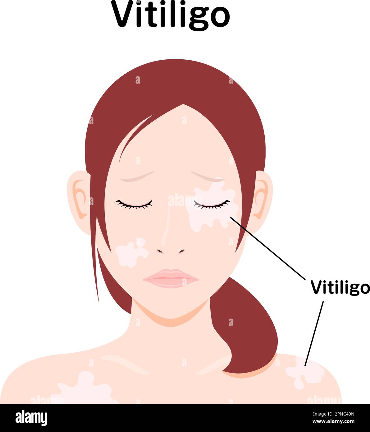 Symptoms of Vitiligo vector illustration Stock Vector Image & Art Alamy