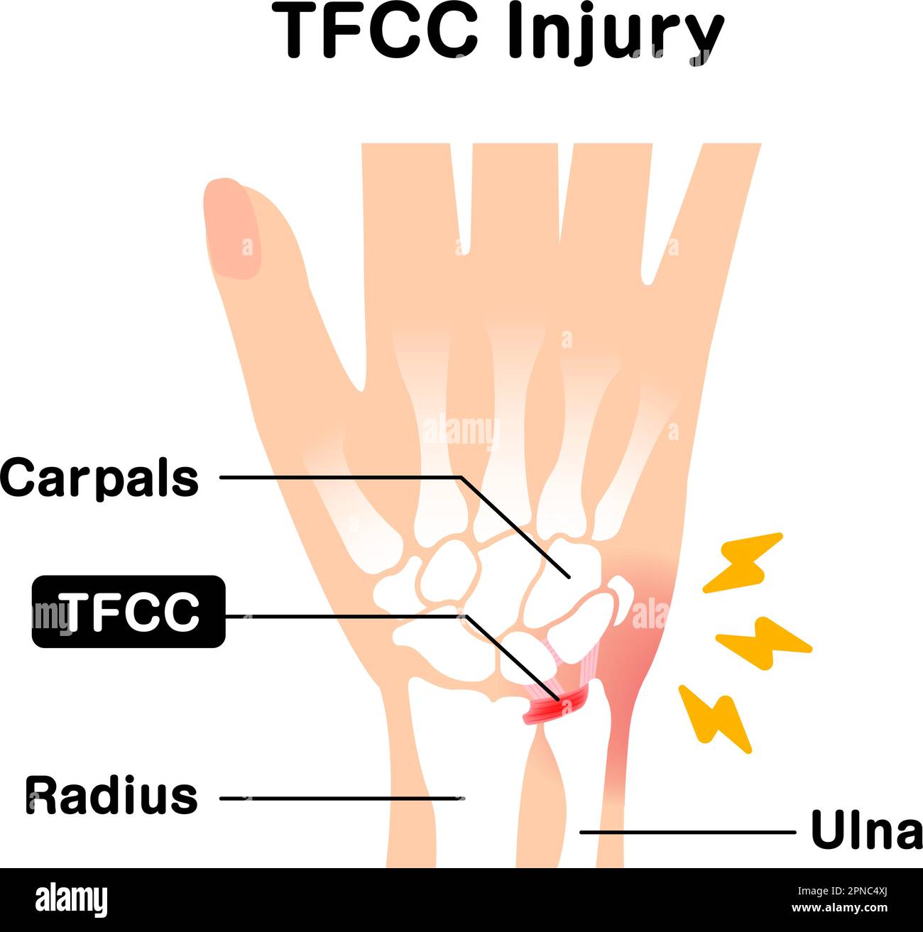 About TFCC injury. Vector illustration Stock Vector