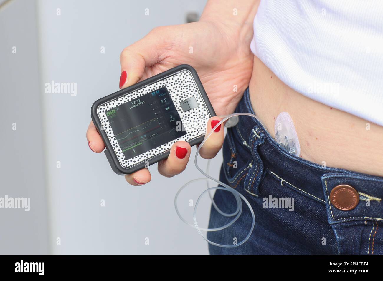 London, UK. March 26, 2023. A general view of a Tandem t:slim X2 insulin pump made by the company Air Liquide. The pump can operate with a Dexcom G6 t Stock Photo