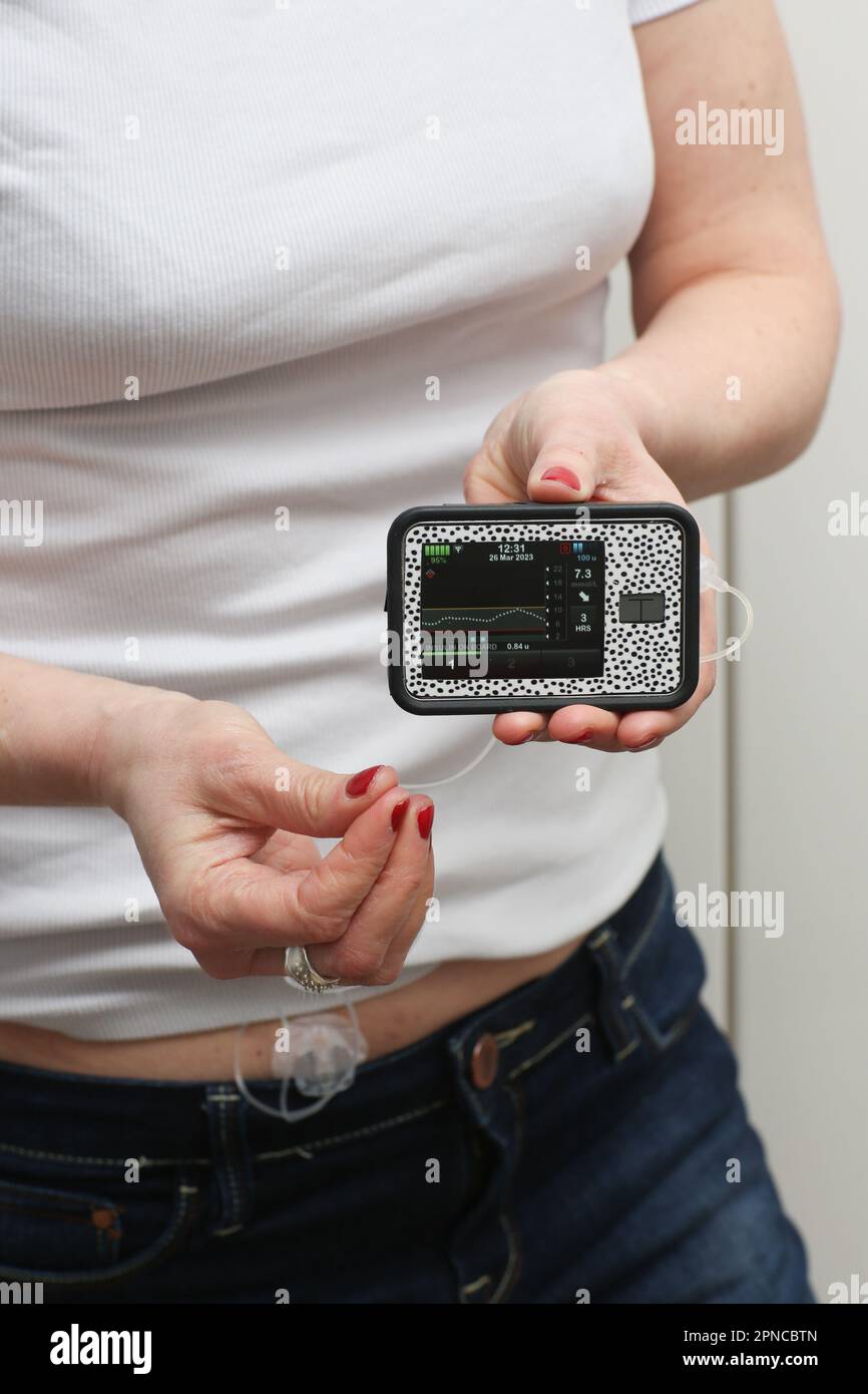 London, UK. March 26, 2023. A general view of a Tandem t:slim X2 insulin pump made by the company Air Liquide. The pump can operate with a Dexcom G6 t Stock Photo