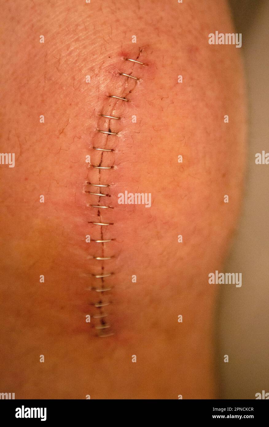 Arthroplasty hires stock photography and images Alamy