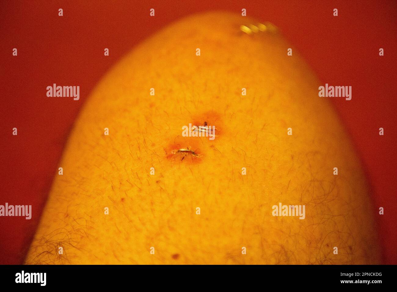 Surgical staple closing incision after arthroplasty