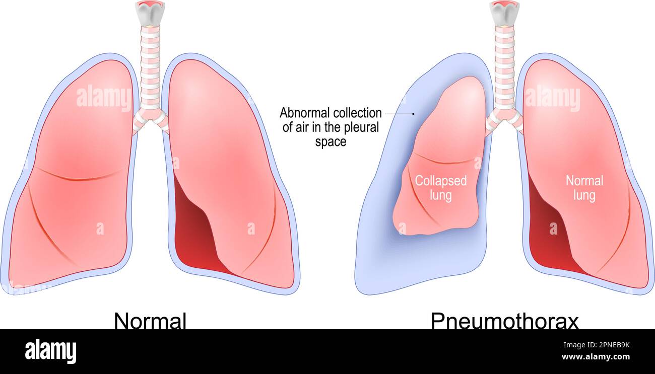Pneumothorax. accumulation of air between the lung and the chest cavity. Normal, and collapsed lungs. Human Respiratory system. Vector illustration Stock Vector