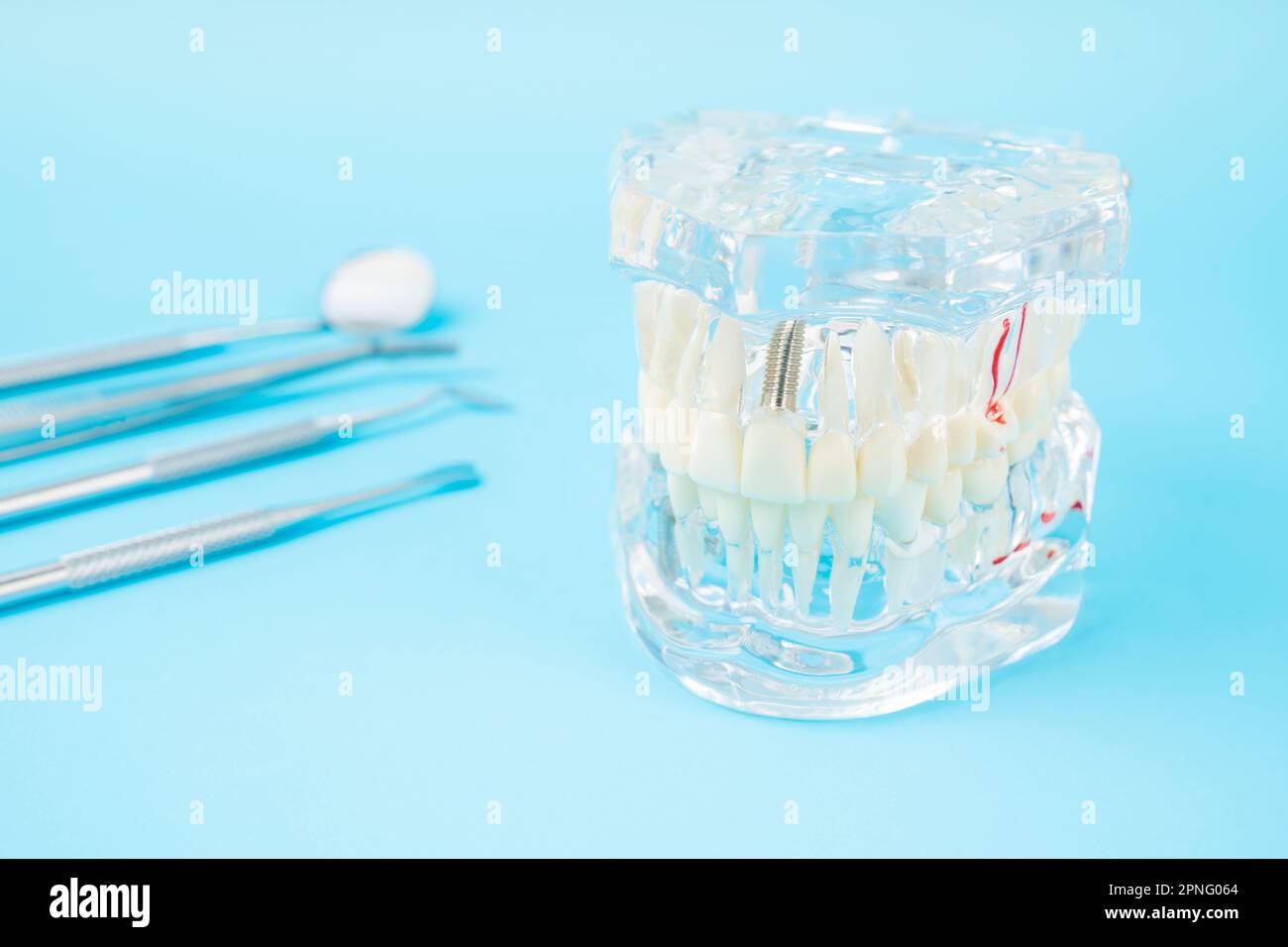 Human jaw or Acrylic dentures model with implants and dental tools on blue background Stock