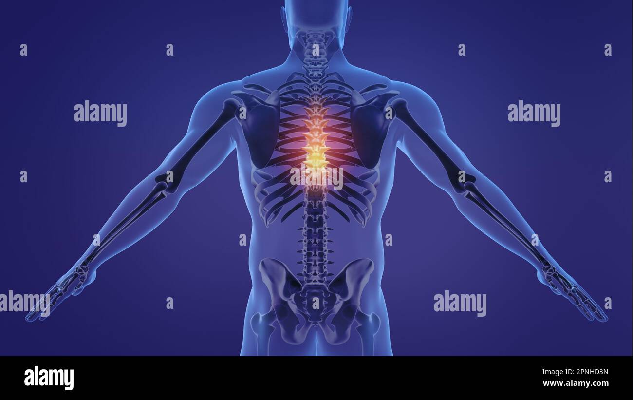 Animation of a painful human spine Stock Photo - Alamy