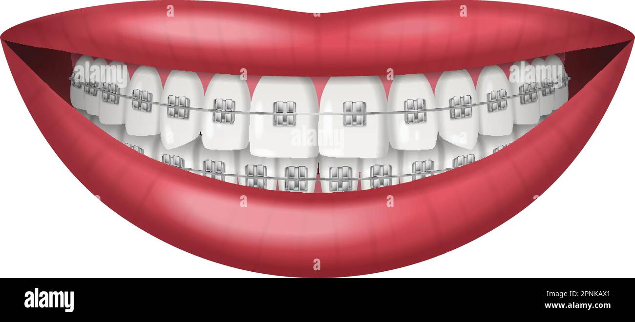 Teeth dental braces realistic isolated on white background vector illustration Stock Vector