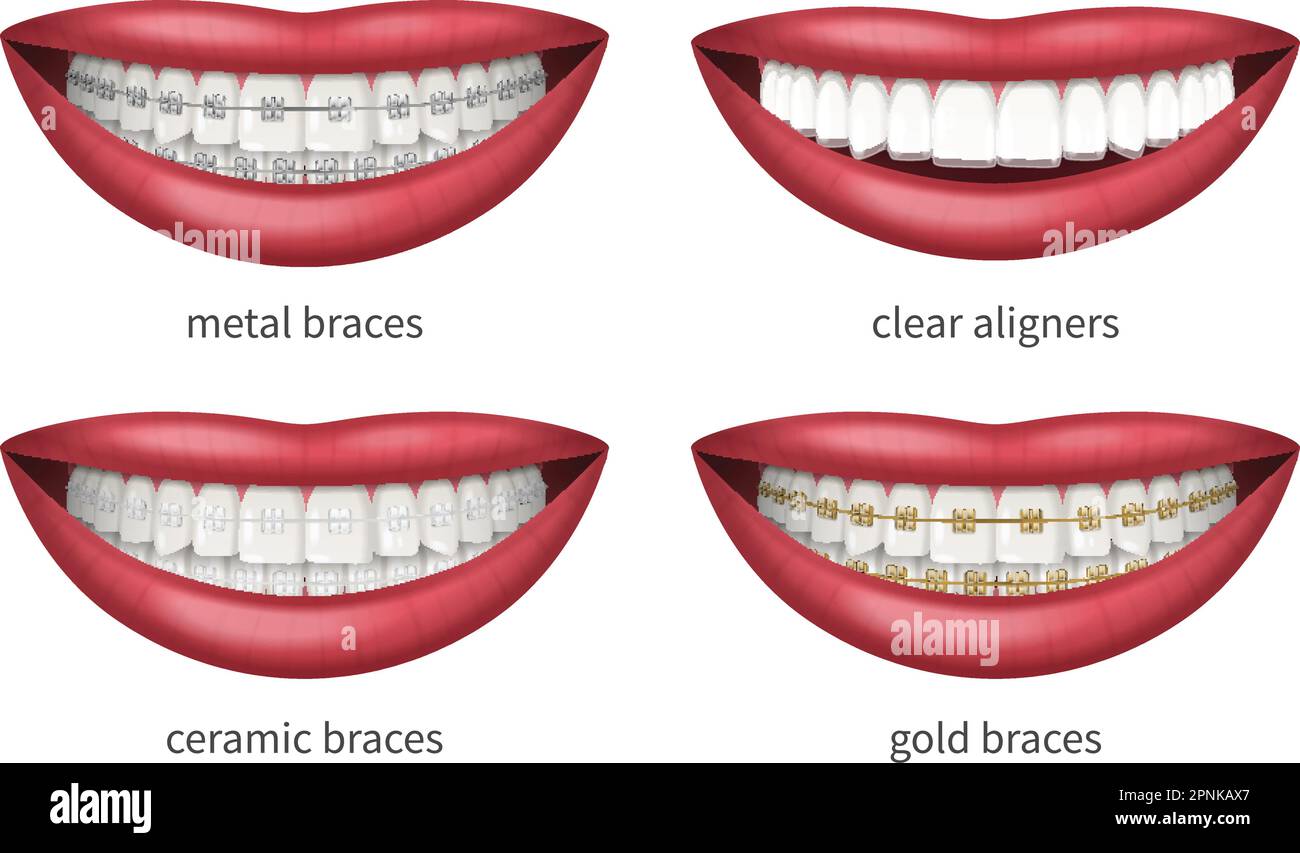 Teeth dental braces icons set with realistic human lips isolated vector