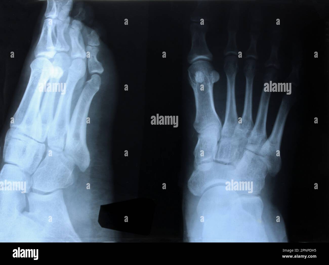 Closeup xray of the foot. condition of bones, joints and soft tissues