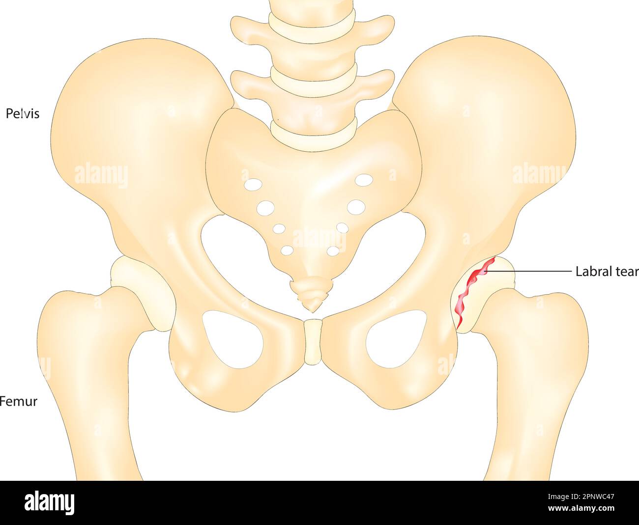 hip labral tear Stock Vector